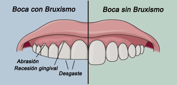 bruxismo balust odontolegs