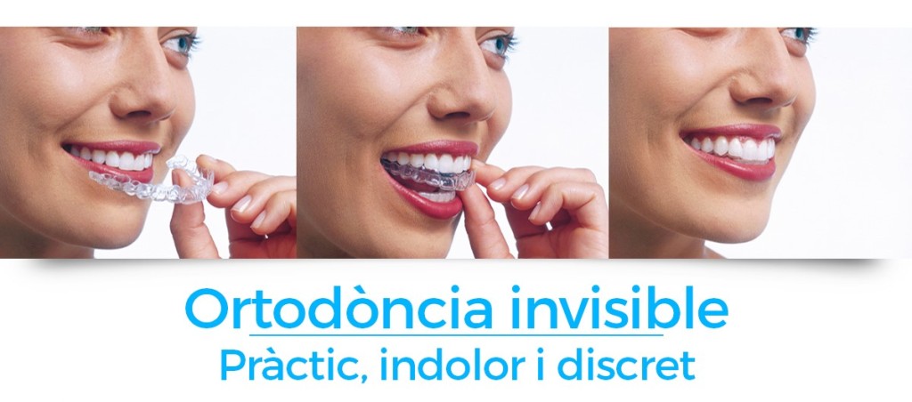 Invisalign-balust-odontolegs-sitges